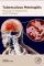 Tuberculous Meningitis