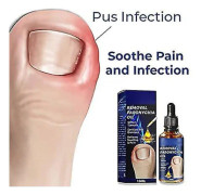 Nagelvårdsolja för att ta bort paronychia, nagelvård och behandling, nagelvård för friska fötter och händer 1PCS