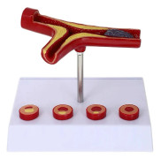 Ateroskleros Medicinsk Modell Blodkärl Anatomisk Modell Kardiovaskulär Modell